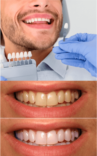 Blanqueamiento dental en Cáceres Capital, clínica especializada en estética dental de Cáceres