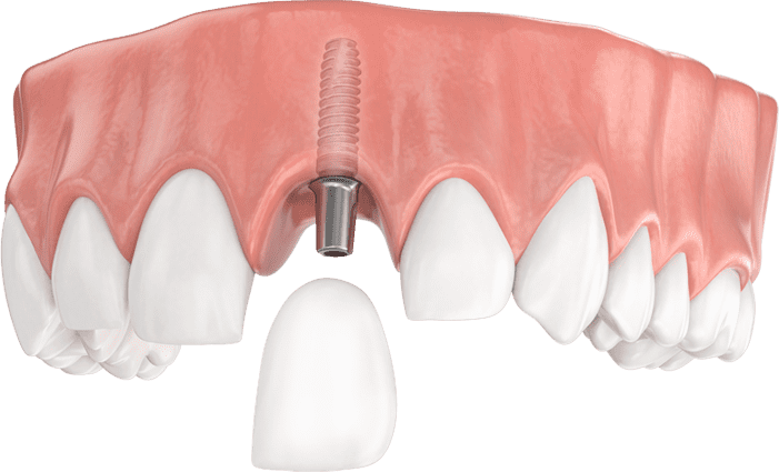 Implantes dentales en Cáceres, clínica especializada en la colocación de implantes dentales de calidad en Cáceres