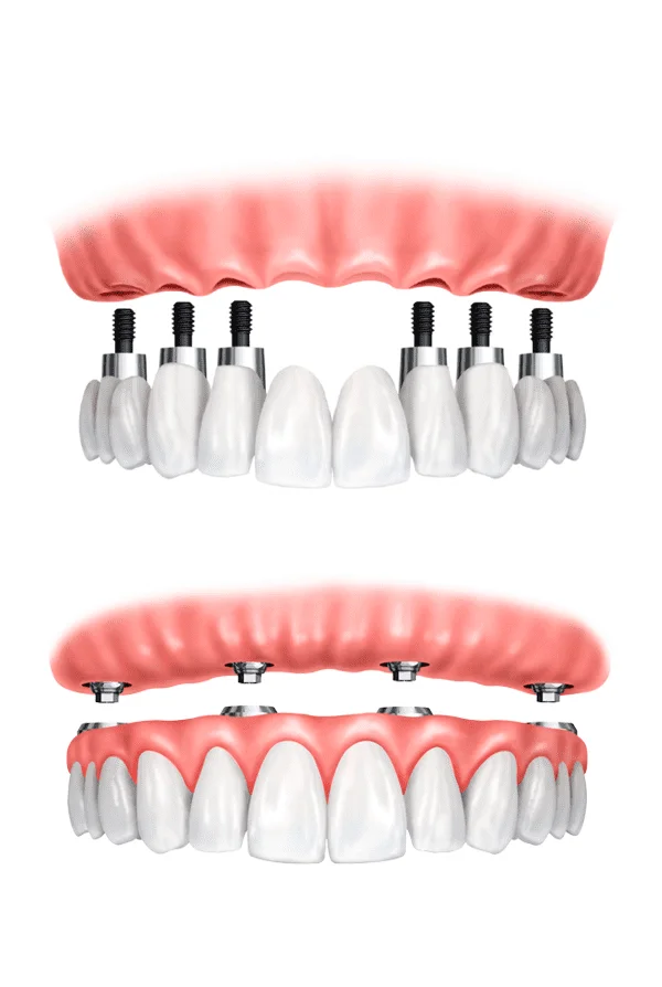 implantes
