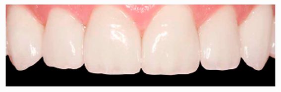 estética dental en Cáceres, carillas dentales de composite Cáceres