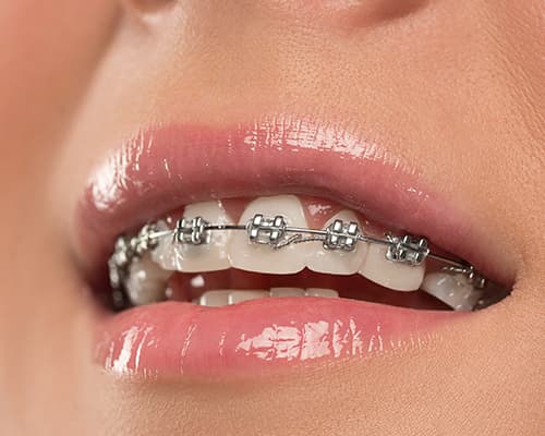 ortodoncia metálica en Cáceres capital, dentistas especializados en brackets metálicos, Brackets metálicos a precio económico