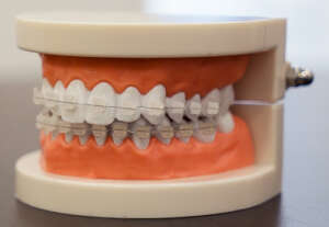 ortodoncia metálica y de porcelana en Cáceres