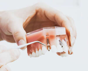 Implantes dentales en Cáceres, la Mejostilla
