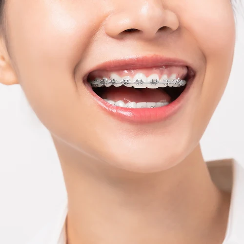 ¿Cómo Saber Si Necesito Ortodoncia Y Cuándo Debo Ponerme Brackets?