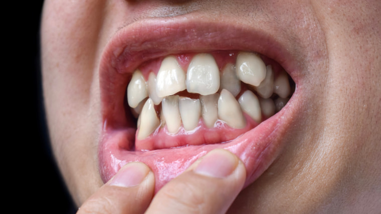 Expertos en tratamiento de Maloclusiones Dentales