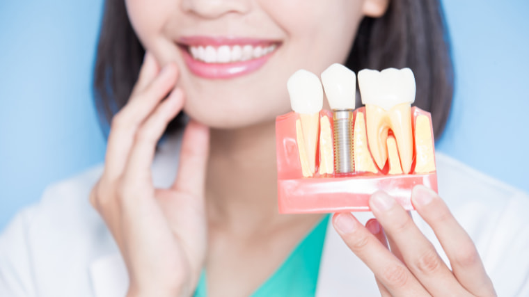 ¿Cuántos años duran los implantes dentales?