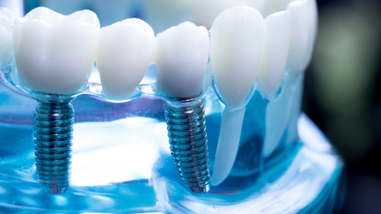¿Por qué se aflojan los tornillos de los implantes dentales?