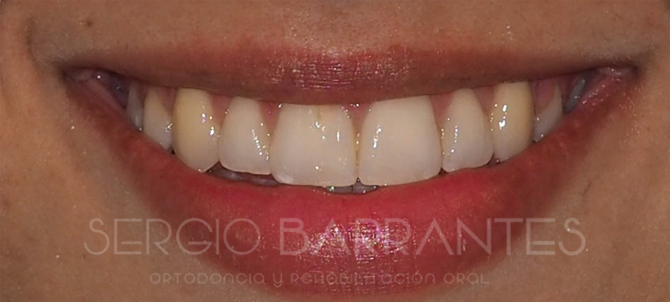 Corrección de apiñamiento severo con extracción y ortodoncia con brackets