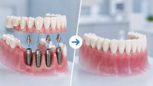 Ventajas de los implantes dentales en el mismo día