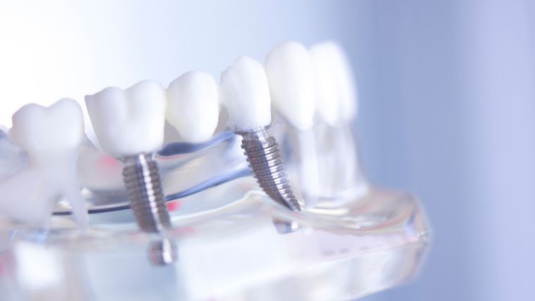 ¿Cuántos implantes dentales se pueden poner en un día?